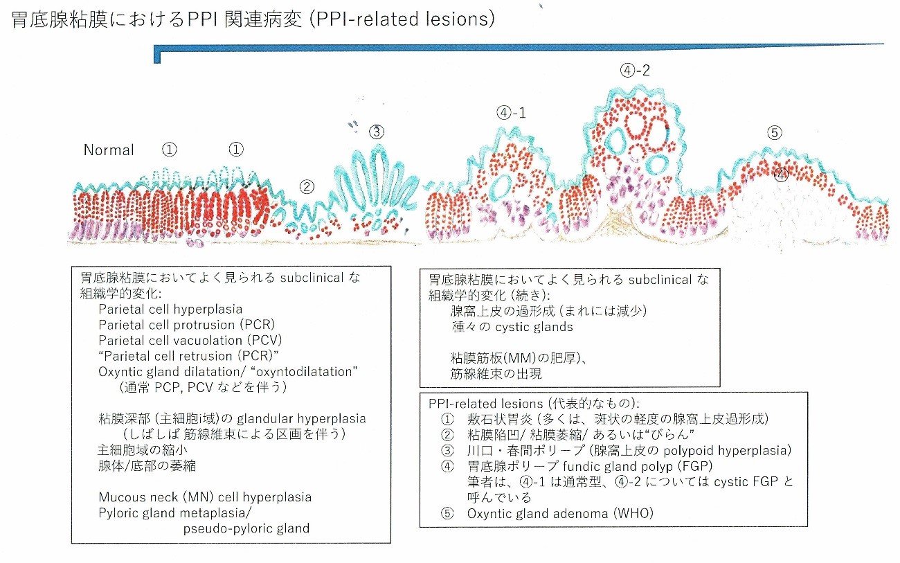 胃底腺粘膜におけるPPI関連病変