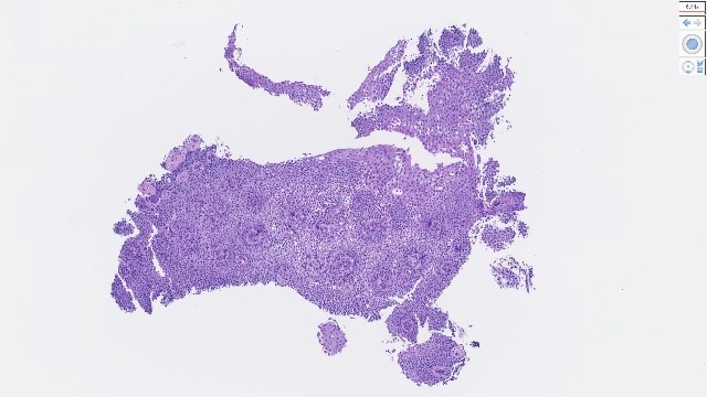 Eosinophilic esophagitis +細胞増生高度