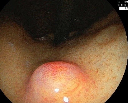 胃底腺型腺癌